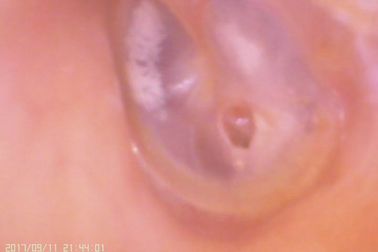 Otoscopio di Digital di video amera del naso e dell'orecchio C per perforazione della membrana timpanica