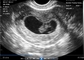 Analizzatore portatile di gravidanza dell'endocavità transvaginale per l'ultrasuono portatile OB/GYN
