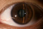3,5&quot; attrezzatura diagnostica di oftalmologia per il diabete di glaucoma