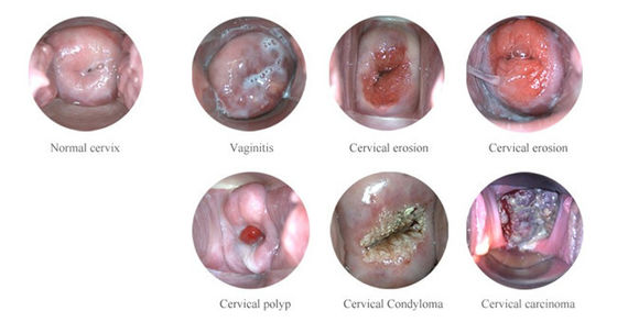Colposcopio elettronico digitale portatile
