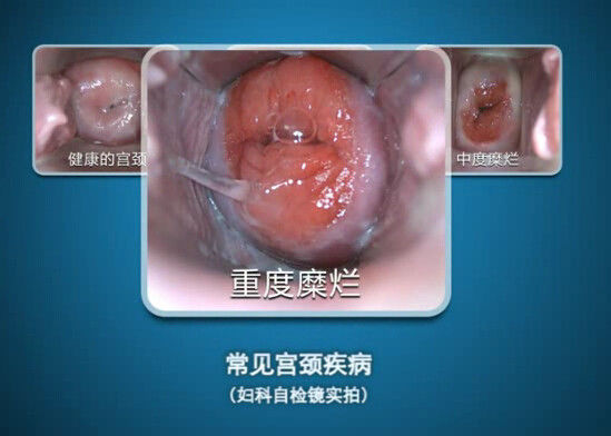 L'endoscopio di Digital Auto-ispeziona la mini colposcopia di Colposcope con gamma di osservazione 70~100mm