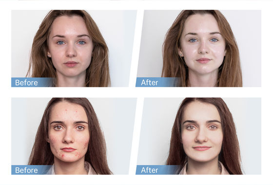 Ultimo Applicatore Automatico di Siero EMS a 4 Poli Hydra Pen H5 per Microneedling Derma del Viso, Penna per la Rigenerazione di Essenza e Collagene della Pelle